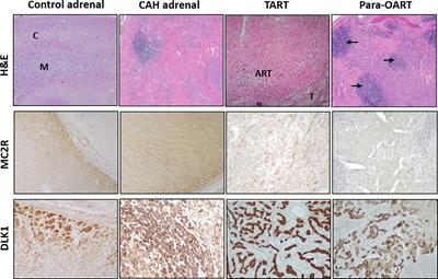 Morphologic and Molecular Characterization of Adrenals and Adrenal Rest Affected by Congenital Adrenal Hyperplasia